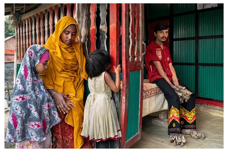 বাংলাদেশের ‘বৃক্ষ মানবের’ করুণ কাহিনী