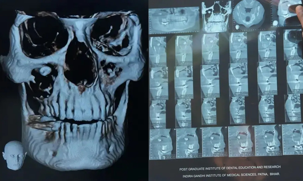 বিরল অস্ত্রোপচারে চোখ থেকে দাঁত অপসারণ