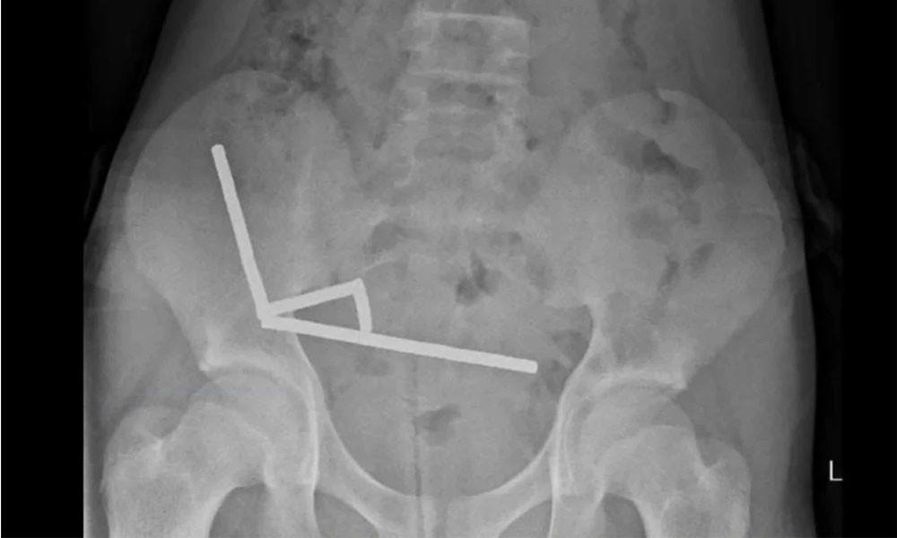 কিশোরের পেটে মিলল ১০০ চুম্বক